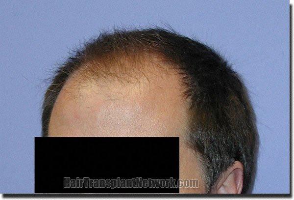 Hair restoration procedure results