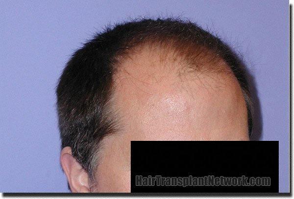 Hair restoration procedure results