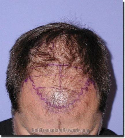 Hair restoration procedure results