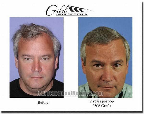 Hair restoration procedure results