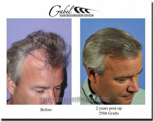 Hair restoration procedure results