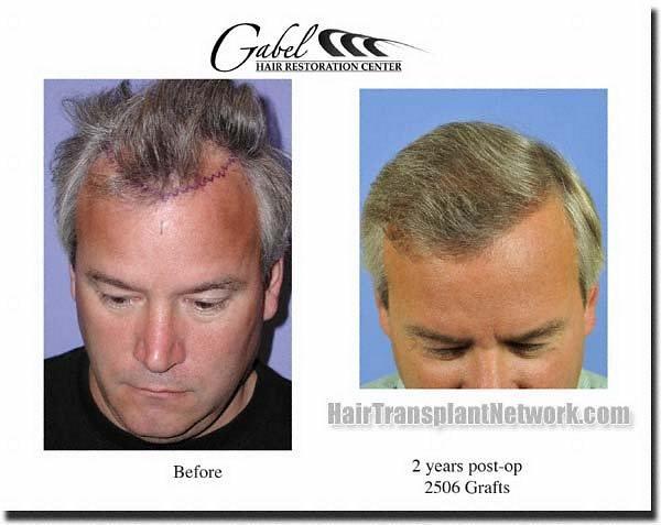 Hair restoration procedure results