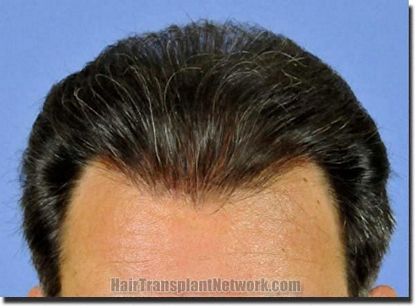 Hair restoration procedure results