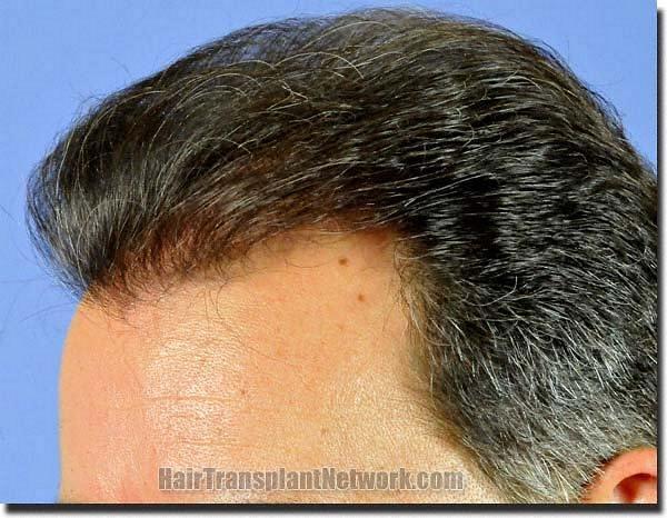 Hair restoration procedure results