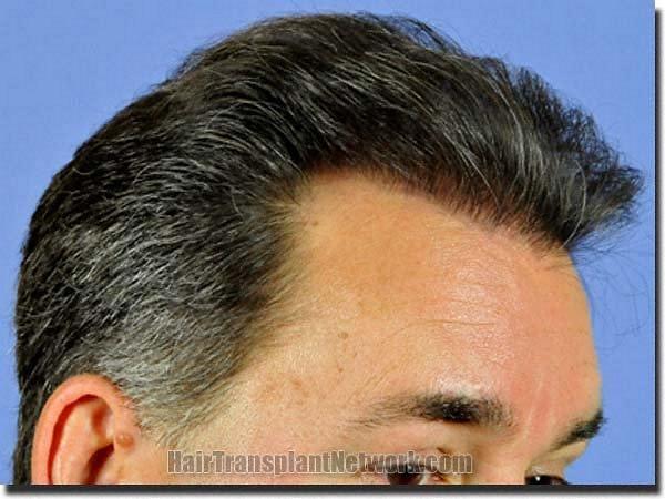 Hair restoration procedure results