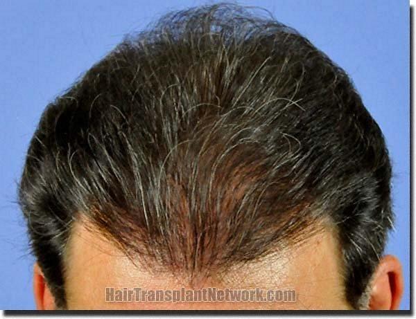 Hair restoration procedure results