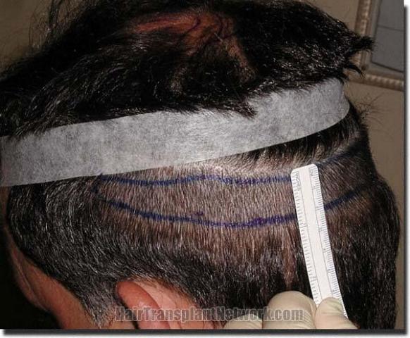 Hair restoration procedure results