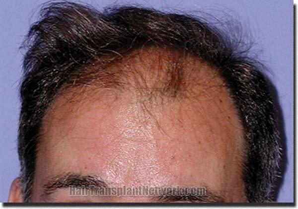 Hair restoration procedure results