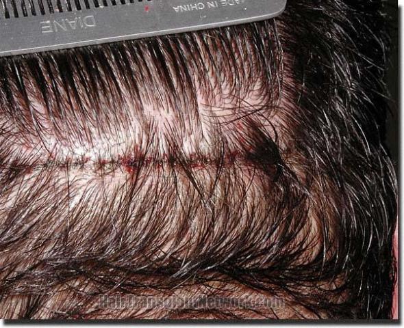 Hair restoration procedure results