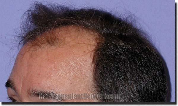 Hair restoration procedure results