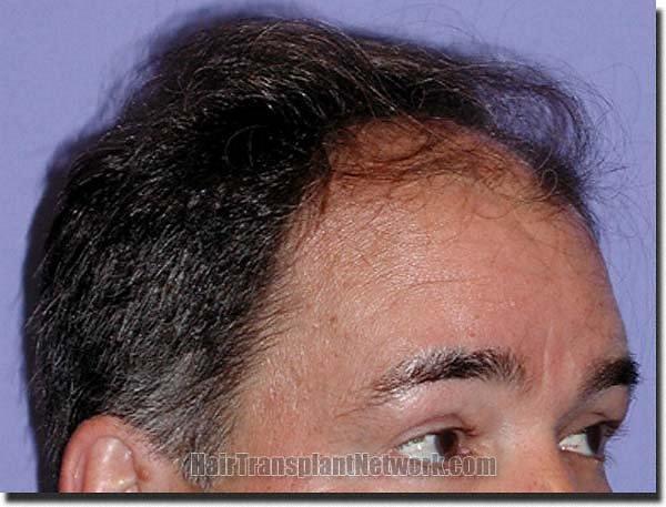 Hair restoration procedure results