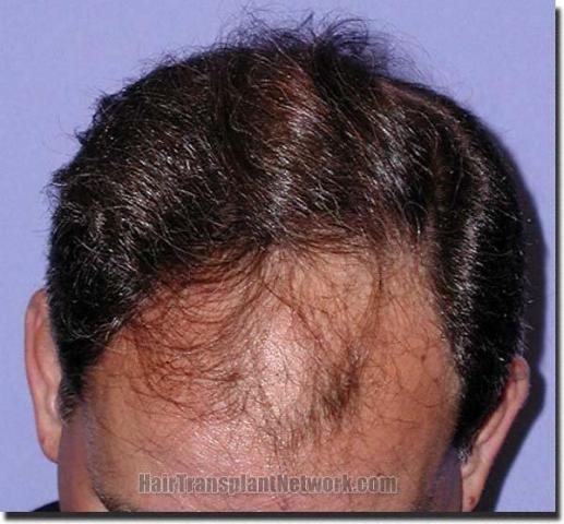 Hair restoration procedure results