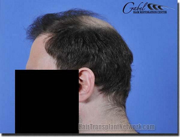 Hair restoration procedure results