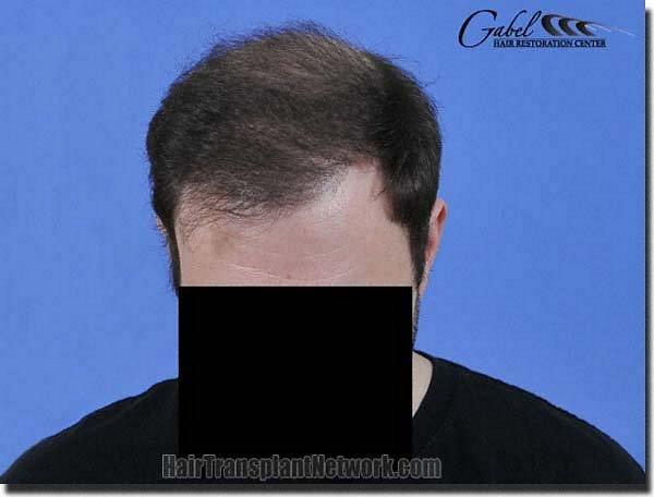 Hair restoration procedure results