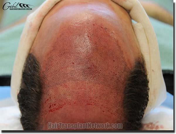 Hair restoration procedure results