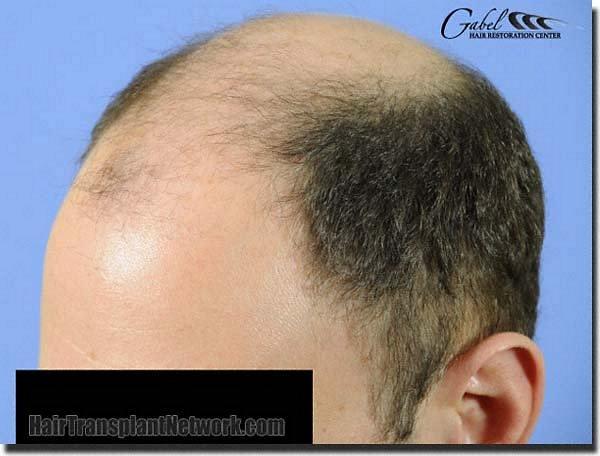 Hair restoration procedure results