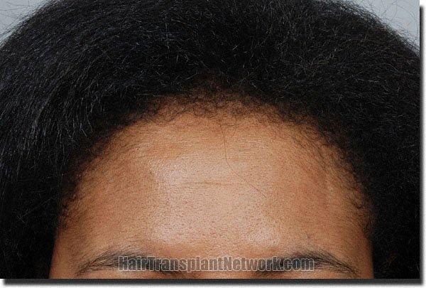 Hair restoration procedure results