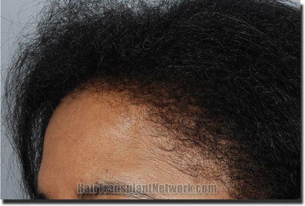 Hair restoration procedure results