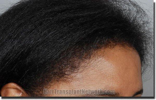 Hair restoration procedure results