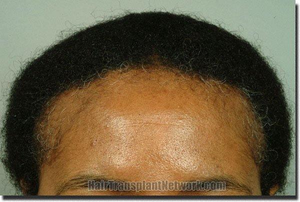 Hair restoration procedure results