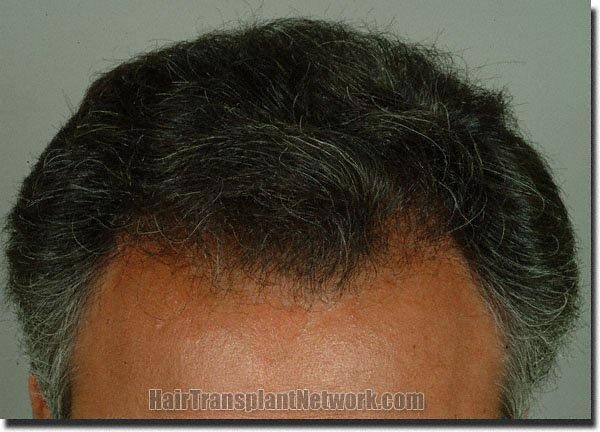 Hair restoration procedure results