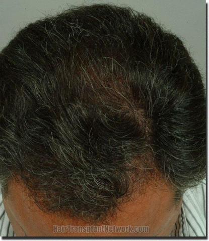 Hair restoration procedure results