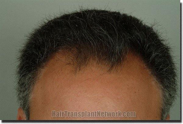 Hair restoration procedure results