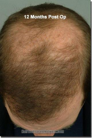 Hair restoration procedure results