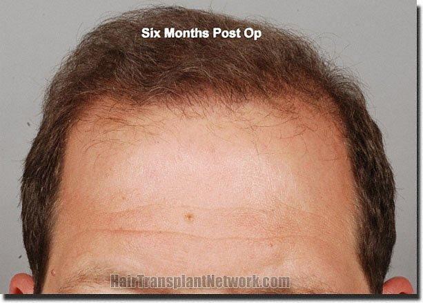 Hair restoration procedure results