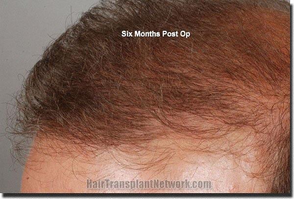 Hair restoration procedure results