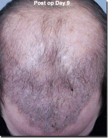 Hair restoration procedure results