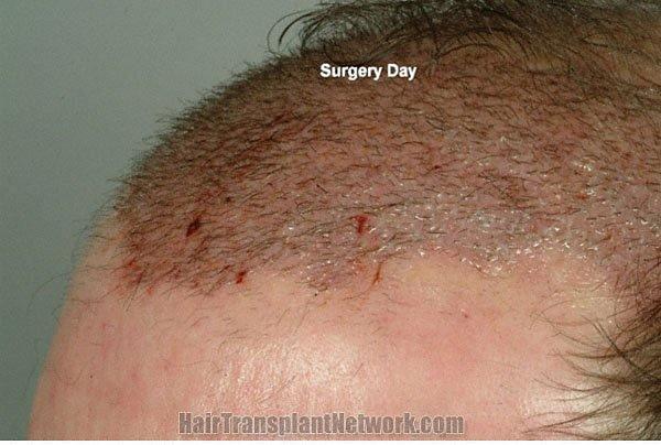 Hair restoration procedure results