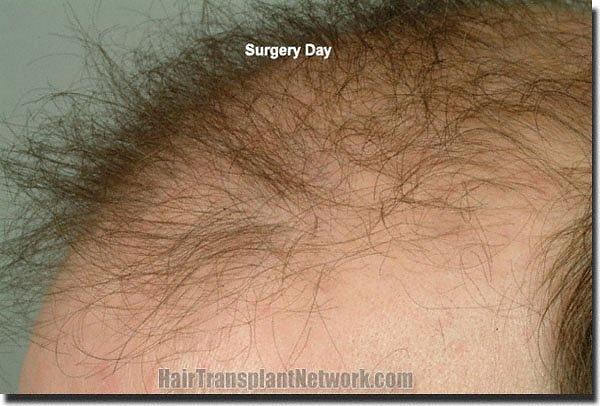 Hair restoration procedure results