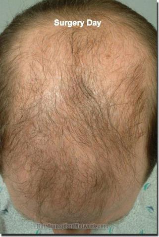 Hair restoration procedure results