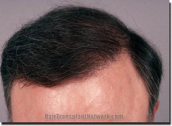 Hair restoration procedure results