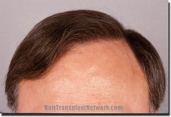 Hair restoration procedure results