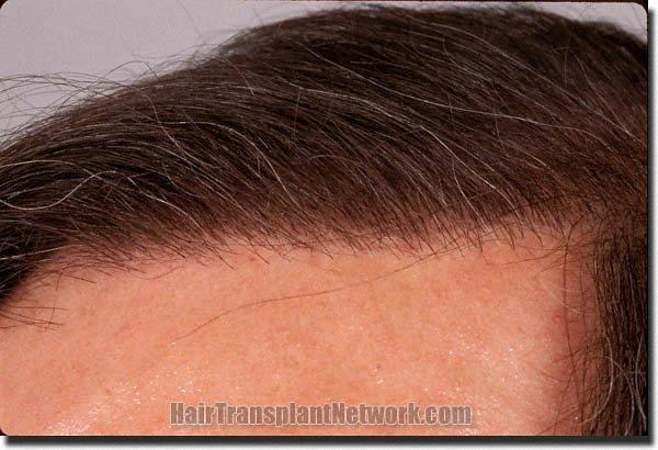 Hair restoration procedure results