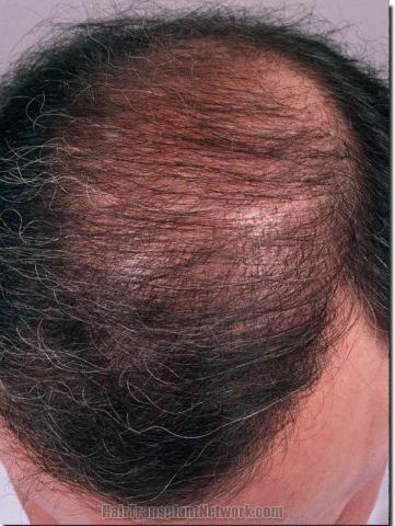 Hair restoration procedure results