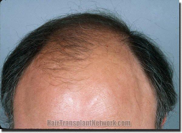 Hair restoration procedure results