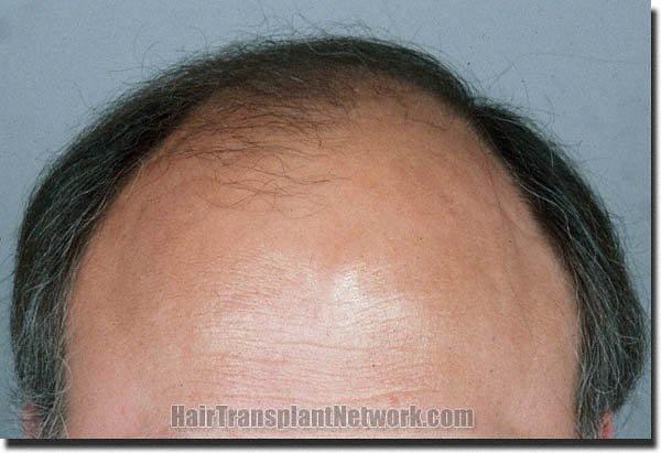 Hair restoration procedure results