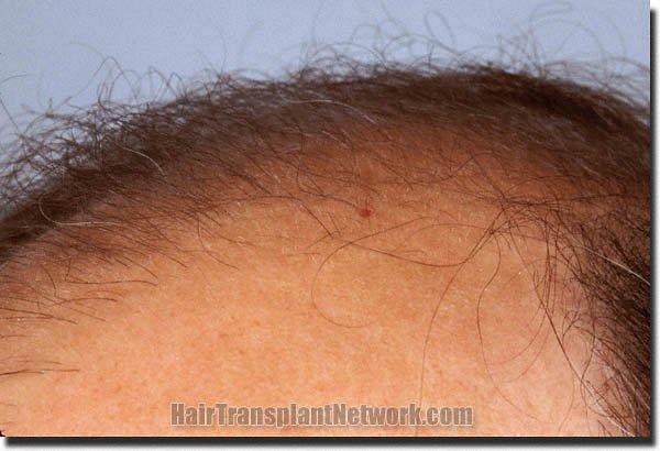 Hair restoration procedure results