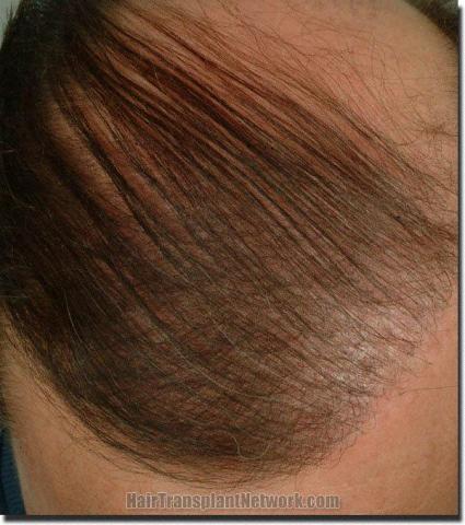 Hair restoration procedure results