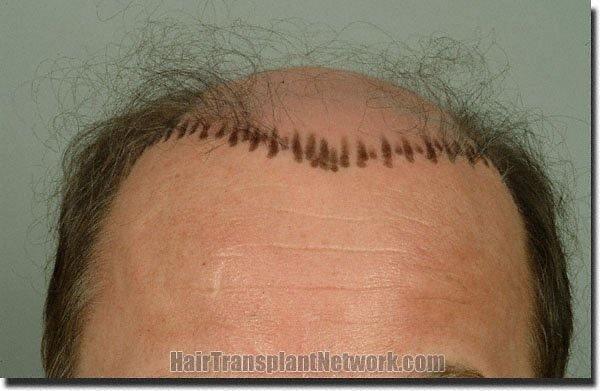 Hair restoration procedure results