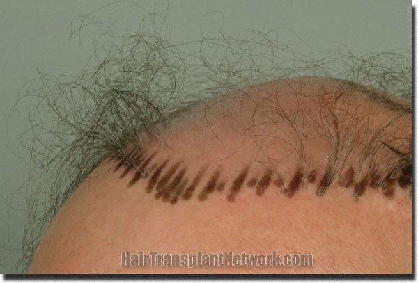 Hair restoration procedure results