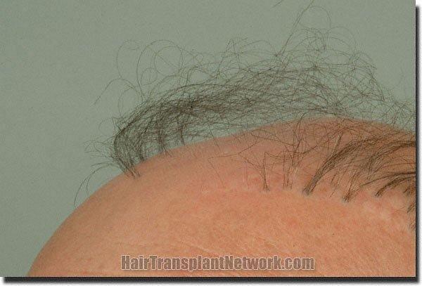 Hair restoration procedure results