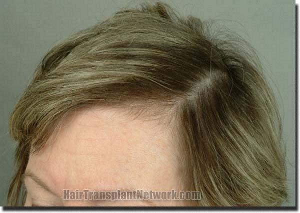 Hair restoration procedure results