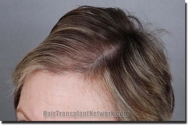 Hair restoration procedure results