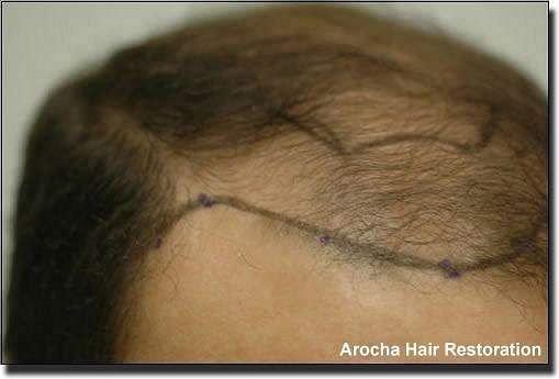 Hair restoration procedure results