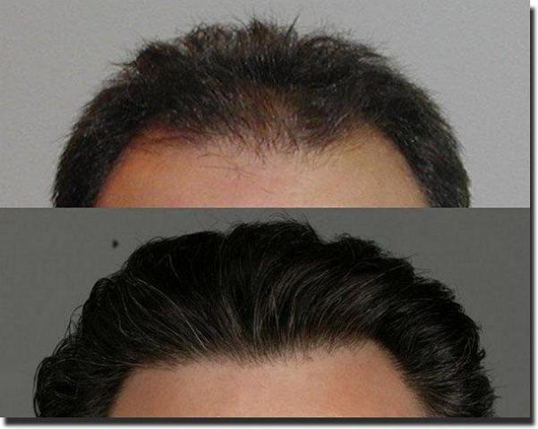 Hair restoration procedure results