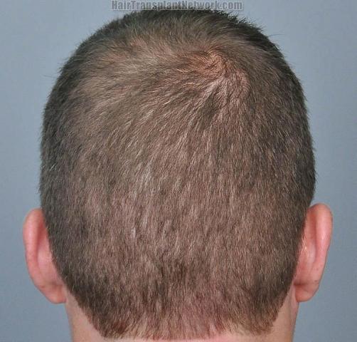 Hair restoration procedure before and after pictures